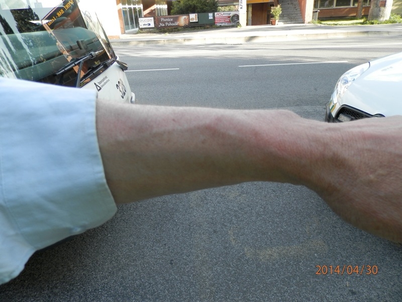 Takhle dopadla řidičova ruka po konfliktu s mladíkem. Foto: DPMLJ