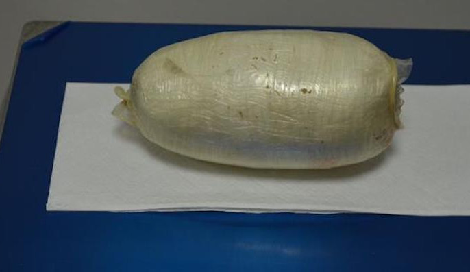 Brazilka pašovala ve svých útrobách kokain. Celníkům musel pomoci až gynekolog.