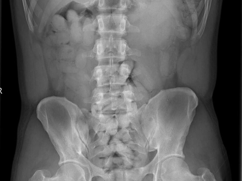 Celníci zadrželi Nigerijce, který pašoval ve svém těle kokain za sedm milionů.