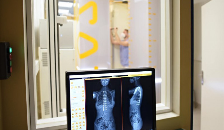 Brněnští lékaři mají jako první v Česku 3D rentgen s nízkou dávkou záření.