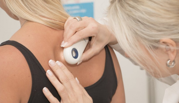 Den melanomu v Jihlavě: Sedm podezření na nádor, nejmladší vyšetřenou byla pětiletá holčička