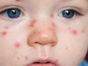 V hradeckých školkách řádí neštovice. Nechat, či nenechat nakazit dítě?