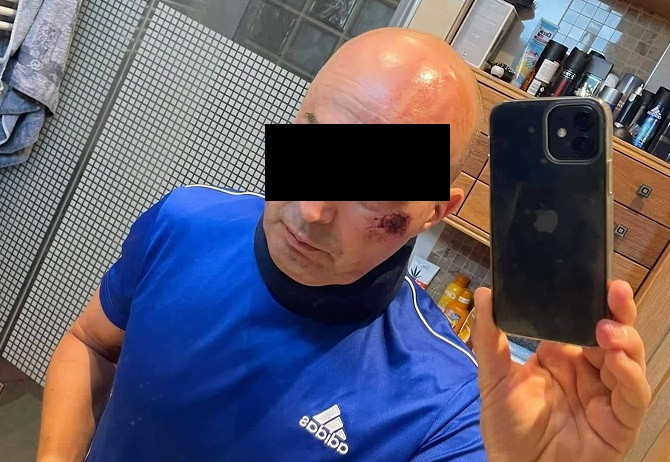 Cyklista se na Českolipsku střetl s traktorem, zachránila jej přilba. Kolo se silným nárazem rozlomilo