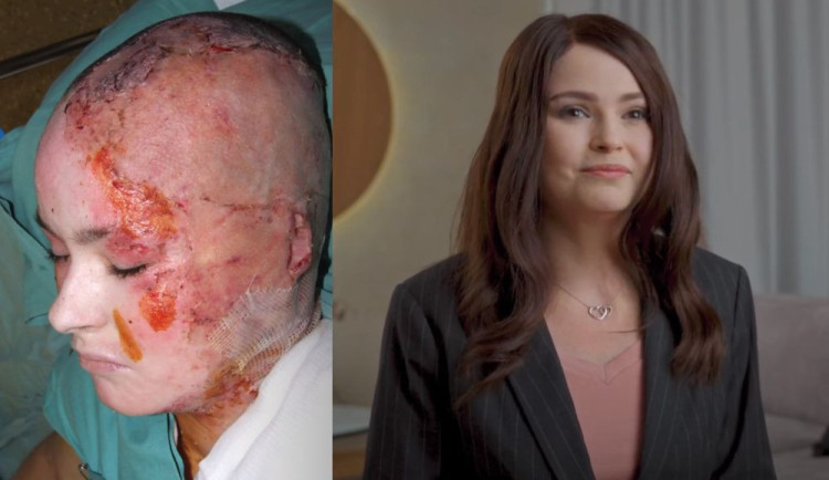 Simona přežila úraz elektrickým proudem. Dnes pomáhá s osvětou.