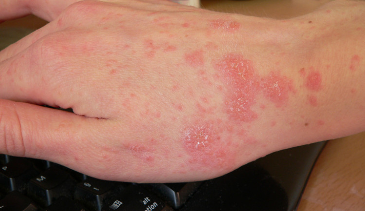 Případů svrabu v Česku dál přibývá, je jich víc než obvykle za celý rok