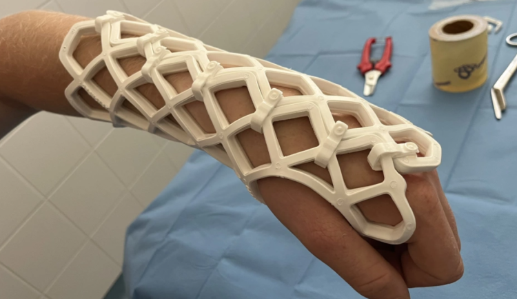 Průlom v léčbě zlomenin. V ostravské fakultní nemocnici je namísto sádry fixují ortézou z uhlíkových vláken