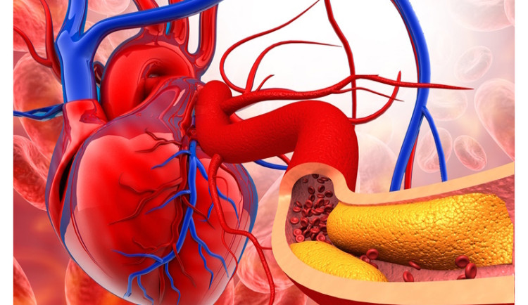 Dědičně zvýšený cholesterol je hrozba, Češi ho příliš neřeší