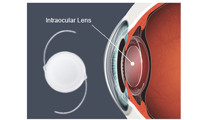 Před 75 lety byla implantována první nitrooční čočka. Vynález zachránil zrak milionům lidí