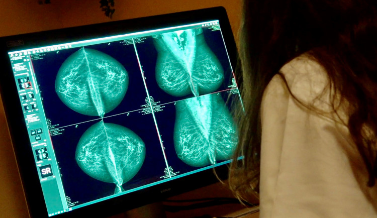 Písecká nemocnice zrychlila mamografické vyšetření, čekací doba klesla na pouhé čtyři dny