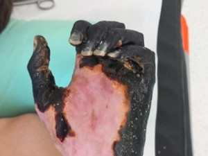 Streptokok ho připravil o prsty i část nohy, bojovník Mareček ale bitvu o život ve FN Olomouc vyhrál