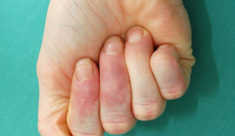 Jak ošetřit amputovaný prst? Zastavit krvácení, zabalit do gázy a volat sanitku