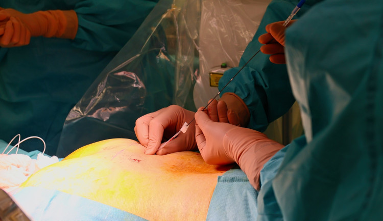 Na Bulovce léčí inkontinenci přelomovou metodou, pomůže chytré zařízení pod kůží