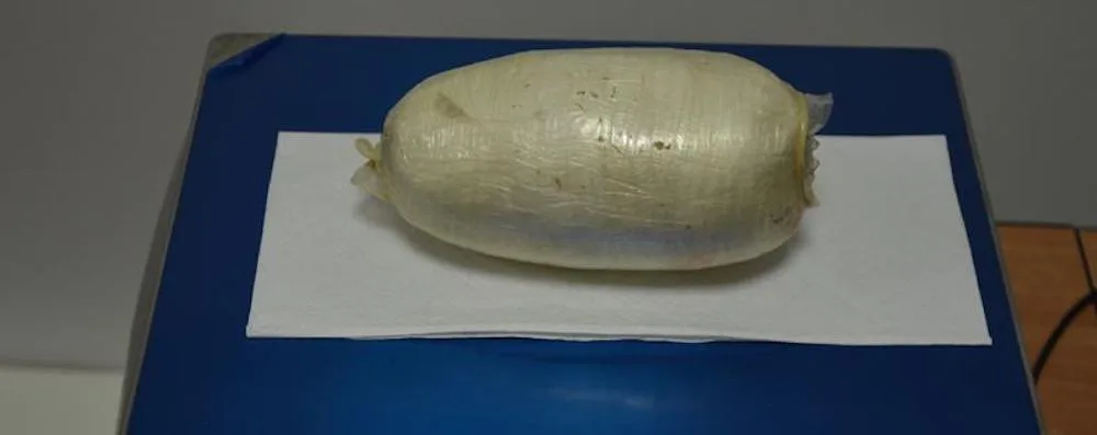 Brazilka pašovala ve svých útrobách kokain. Celníkům musel pomoci až gynekolog.