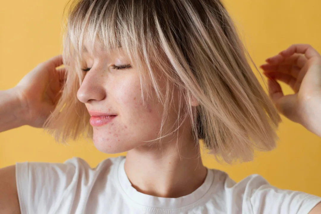 Jak se zbavit akné: praktický průvodce pro zdravou pleť