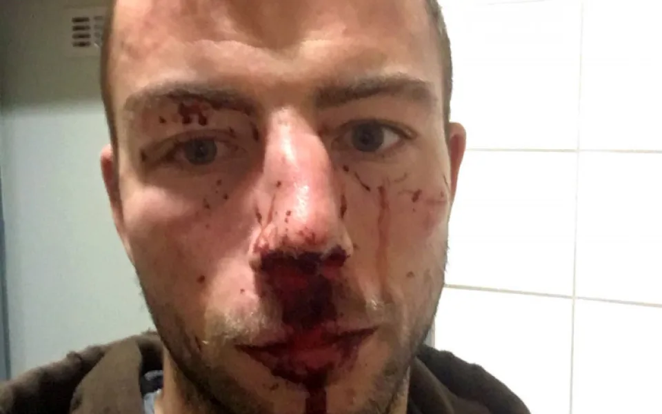 Jihlavský hokejista Michal Hlinka byl napaden. Skončil s otřesem mozku a zlomeným nosem v nemocnici.