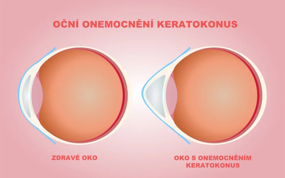 Keratokonus deformuje rohovku: Nejmodernější femtosekundový laser na světě pomáhá pacientům léčit vzácné oční onemocnění