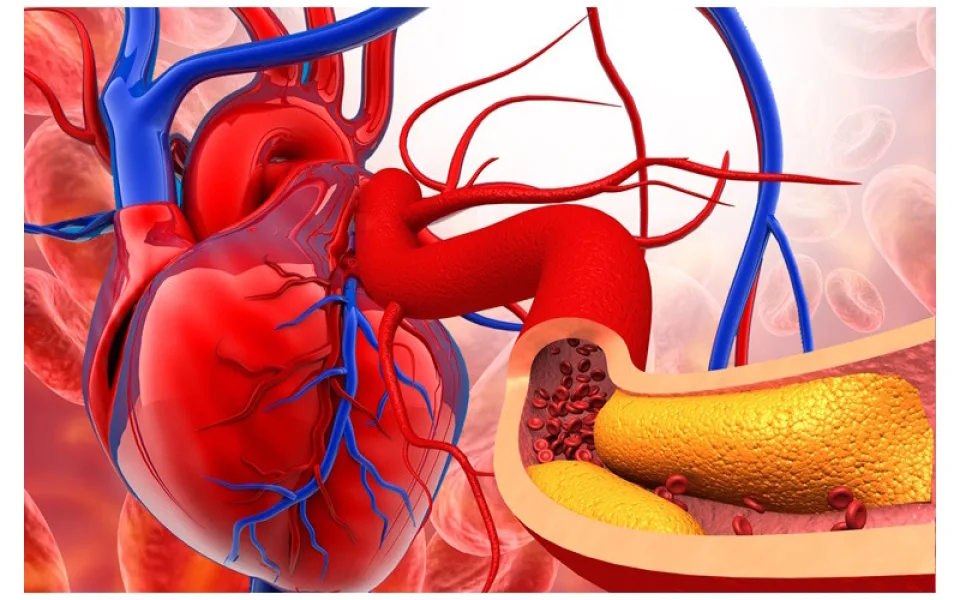 Dědičně zvýšený cholesterol je hrozba, Češi ho příliš neřeší